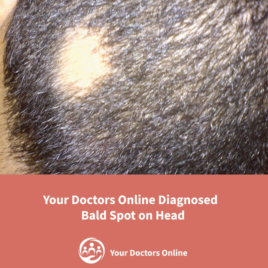 Alopecia Areata Read how Your Doctors online helped Peter diagnose the bald spot on his head