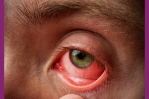 Your Doctors Online helped me treat bacterial conjunctivitis