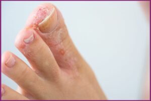 Your Doctors Online Cured My Athlete's Foot!