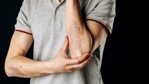 Autoimmune diseases