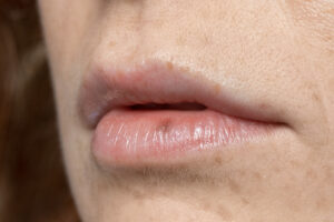 small bumps on lips no pain